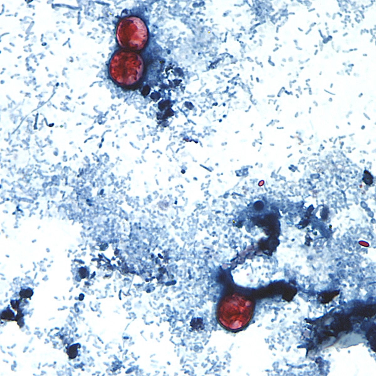 Cleveland confirms 18 cases of disease causing explosive diarrhea